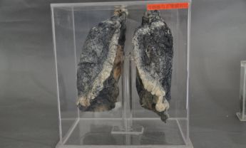 吸烟肺与正常肺对比